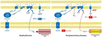 Mitochondrial Bioenergetics in the Metabolic Myopathy Accompanying Peripheral Artery Disease
